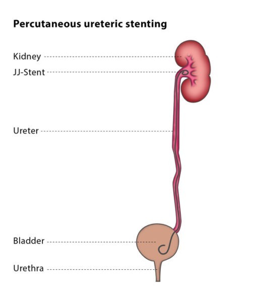 DJ stent with pusher urology 6Fr 26cm 50 pieces DJ stent with pusher urology 6Fr 26cm 50 pieces